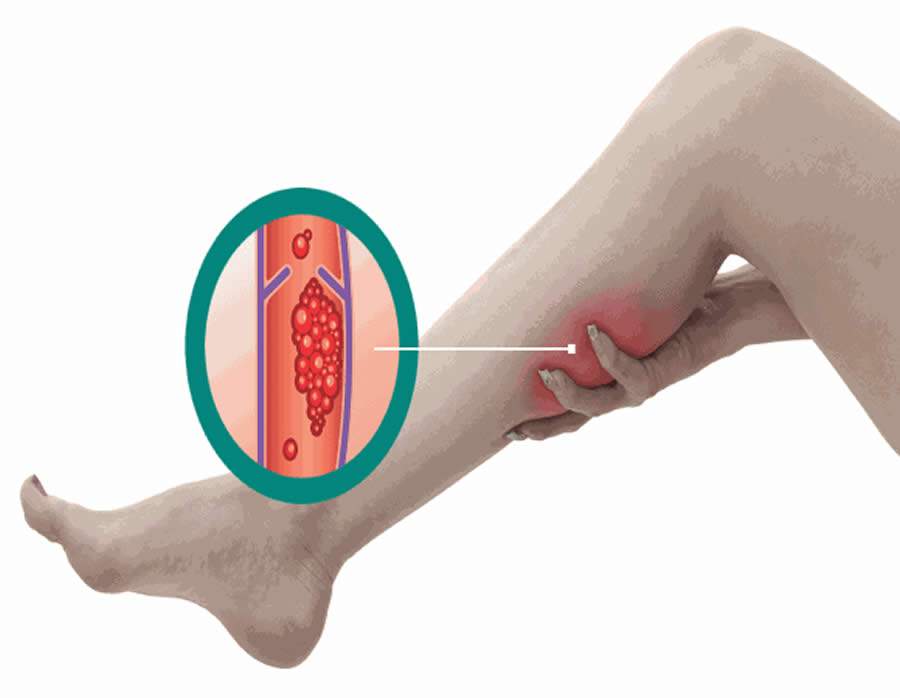 Fraturas, quedas e acidentes podem causar trombose