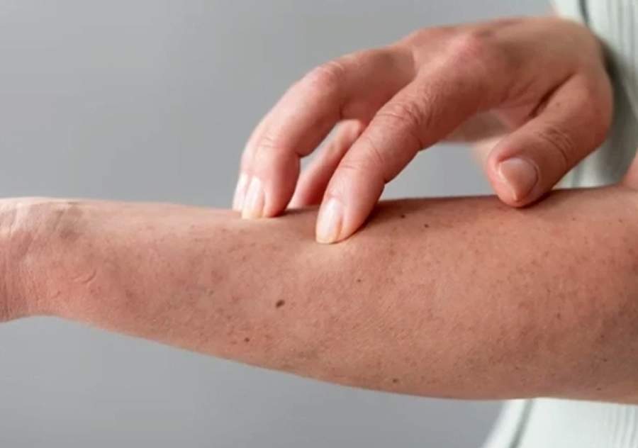 Abscessos: O Alerta Doloroso do Corpo Que N&atilde;o Deve Ser Ignorado