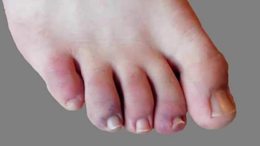 ‘Covid Toes’: estudo aponta lesões roxas nos dedos do pé e da mão como novo sintoma do Covid-19