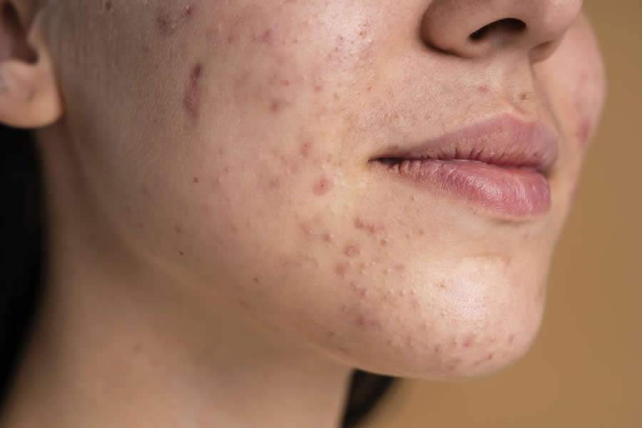  Adolescente com acne, quadro que desencadeou a depressão - Divulgação