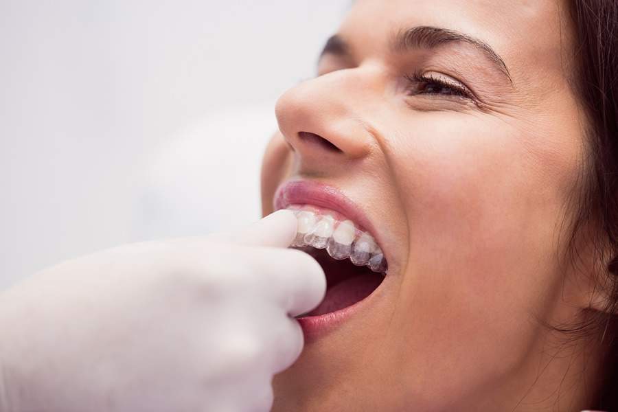 Alinhador dental transparente é nova aposta entre pacientes