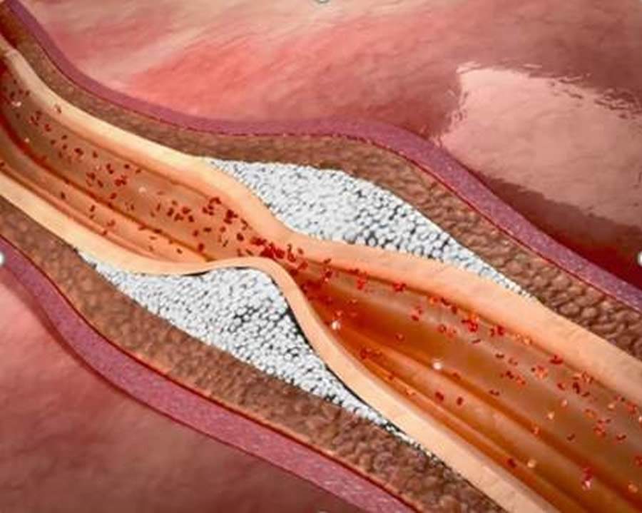 Biolab-Vitamina-K2-tem-papel-de-destaque-na-prevencao-e-controle-da-calcificacao-arterial-Foto-Divulgacao