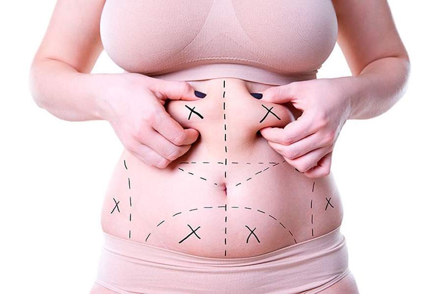 Curiosidades Que Voc&ecirc; Precisa Saber Sobre Lipoaspira&ccedil;&atilde;o