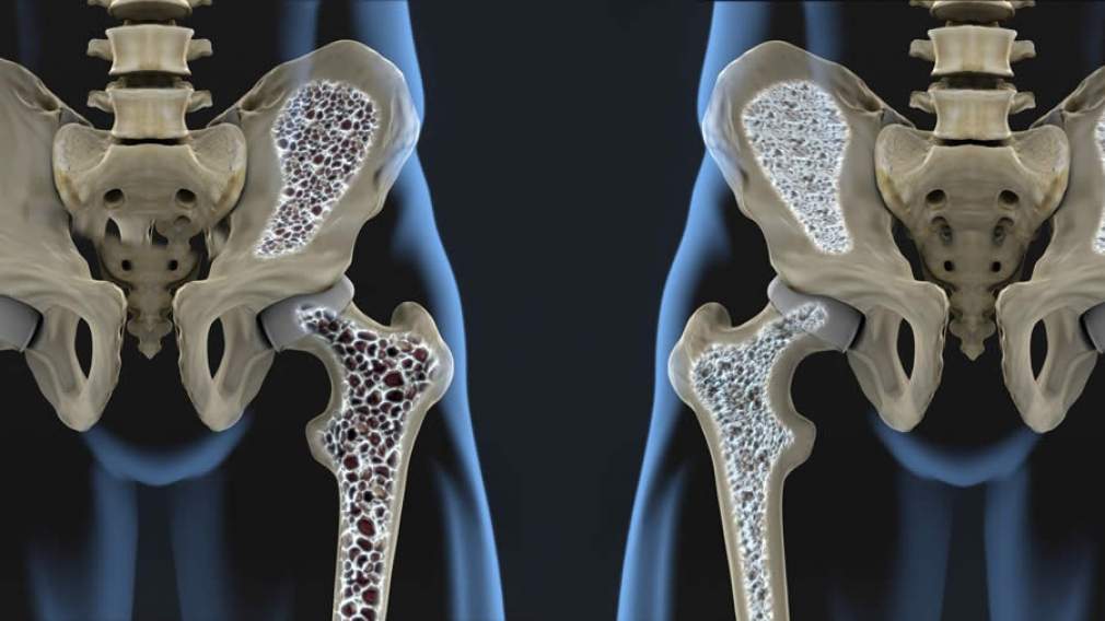 Osteoporose atinge principalmente mulheres na pós-menopausa 
