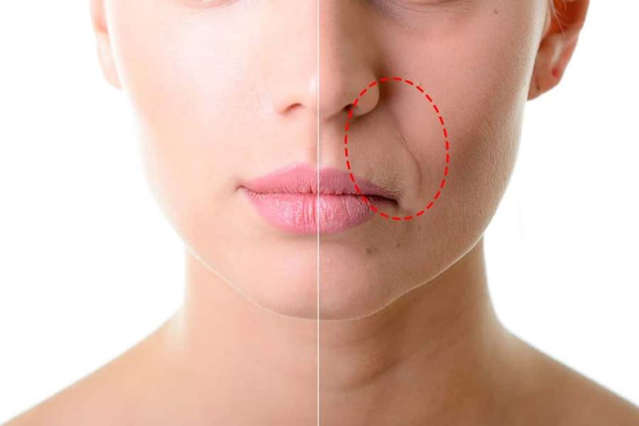 Bigode Chin&ecirc;s: Como se Livrar e Evitar essas Temidas Rugas