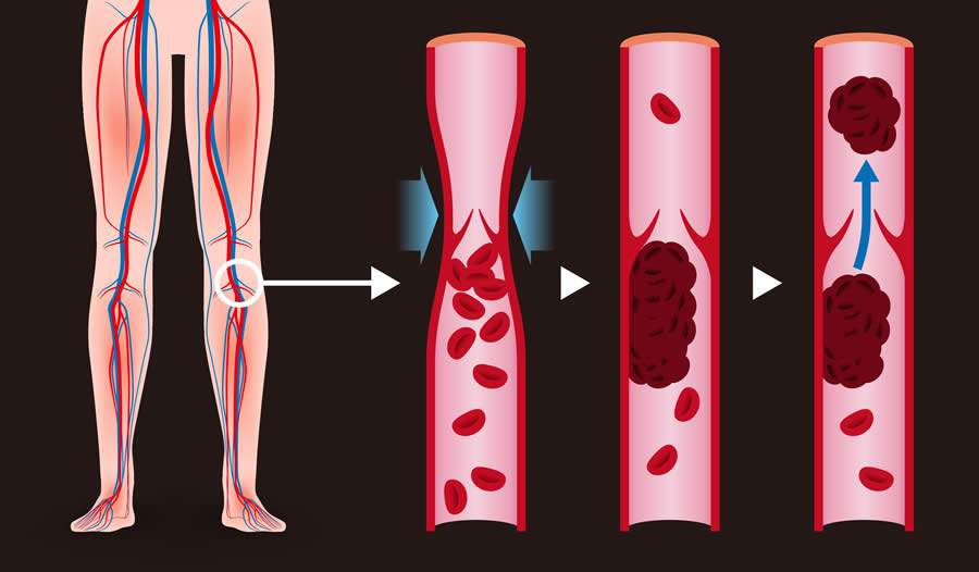Trombose Venosa Profunda representa um risco grave à saúde vascular