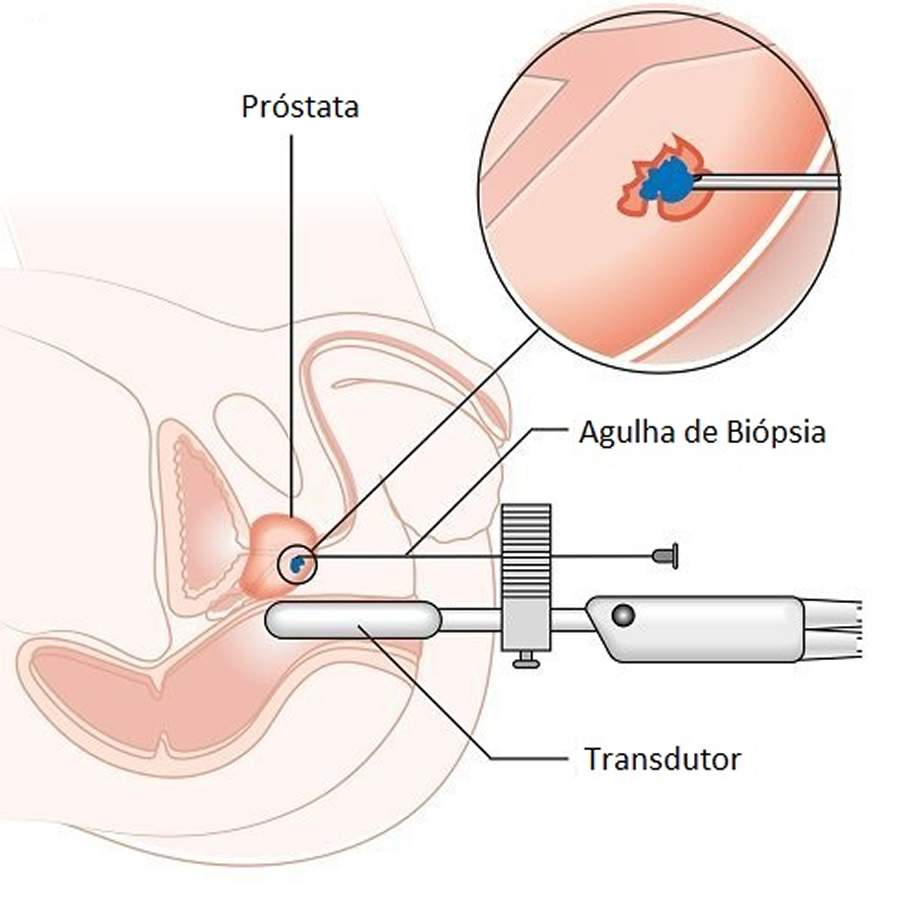 Novembro Azul: novo tipo de biópsia para detecção do câncer de próstata ganha espaço no Brasil