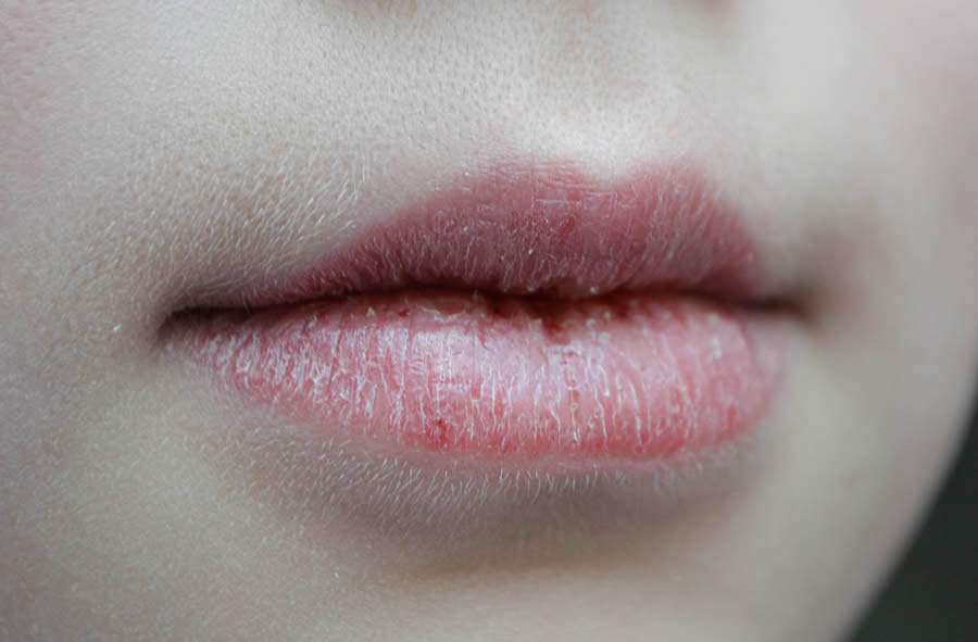 Lábios secos e rachados - Freepik