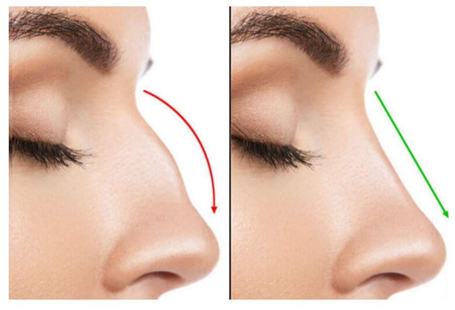 Quando a plástica no nariz vai além da estética