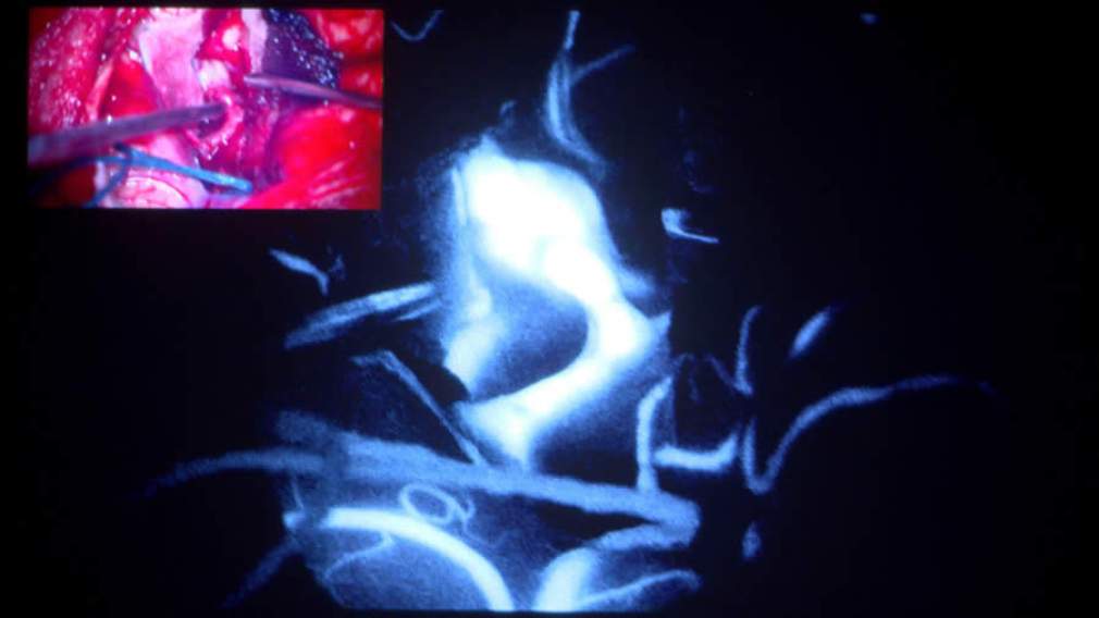 Imagem de cirurgia do Dr. Koshiro Nishikuni e equipe com o uso do KINEVO 900 no HSC, com aplicação do sistema de fluorescência intraoperatória (Foto: Divulgação)