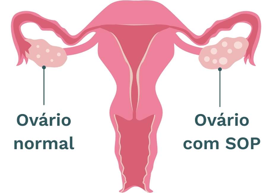 Setembro: Mês da conscientização sobre a Síndrome de Ovários Policísticos