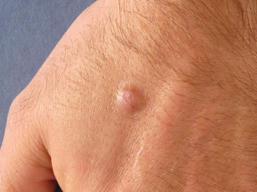 Caroço firme na pele pode ser dermatofibroma, lesão que pode surgir por picada de inseto