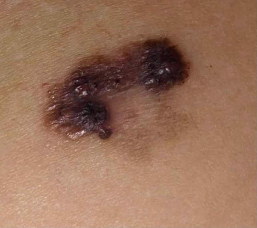 Em manchas e pintas pelo corpo pessoas devem observar sua evolu&ccedil;&atilde;o, contornos irregulares, tamanho e outros fatores - Divulga&ccedil;&atilde;o